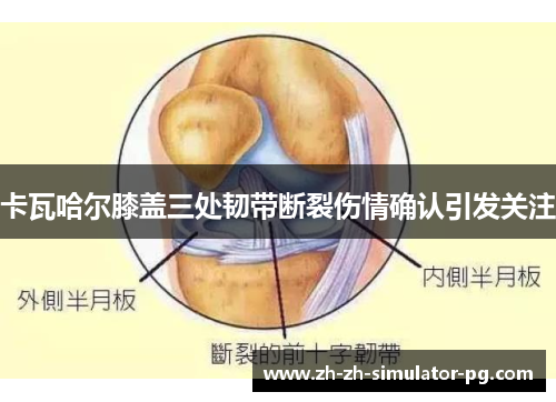 卡瓦哈尔膝盖三处韧带断裂伤情确认引发关注 卡瓦哈尔膝盖三处韧带断裂伤情确认引发关注